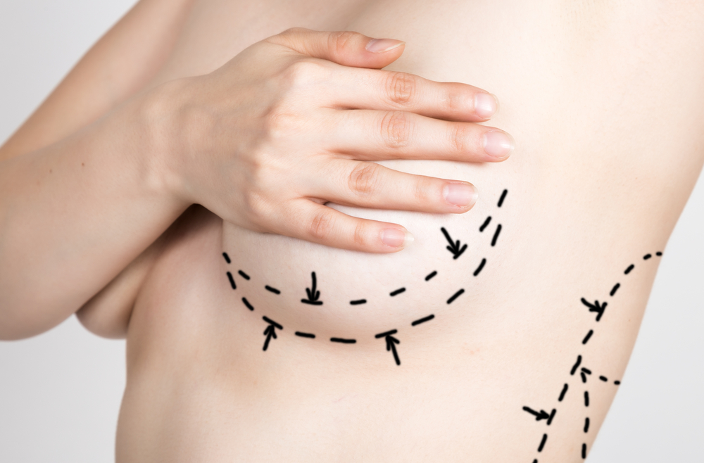 Breast augmentation planning diagram.