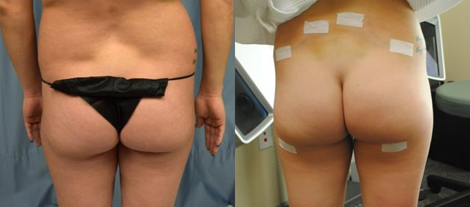 Buttock before and after fat grafting procedure