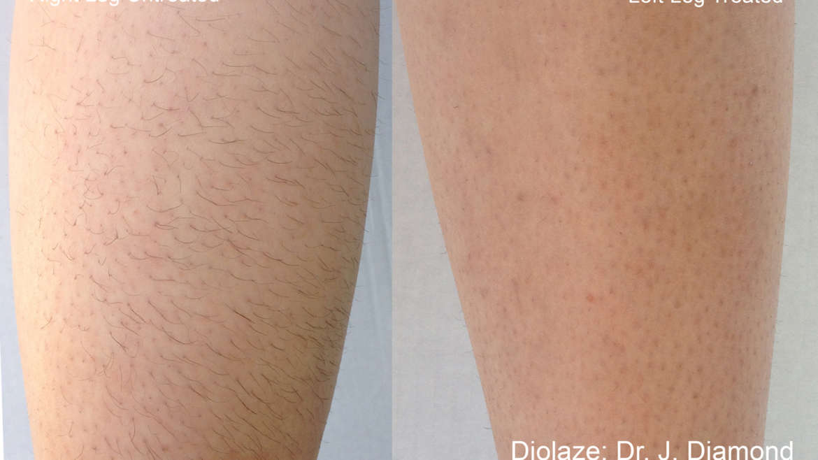 Leg before and after having surgical hair removal.