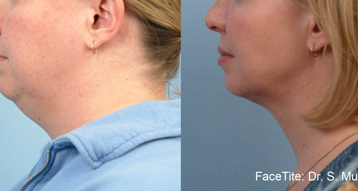 Profile of a woman before and after FaceTite facial contouring surgery