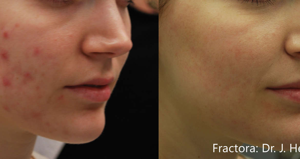 Profile of a woman before and after a fractora surgical procedure.