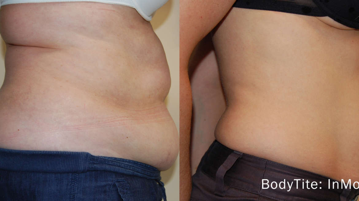Bodytite full body renewal body contouring procedure.