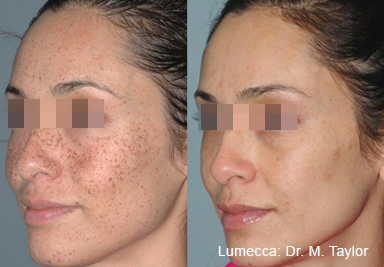 Woman's face before and after Lumecca treatment.