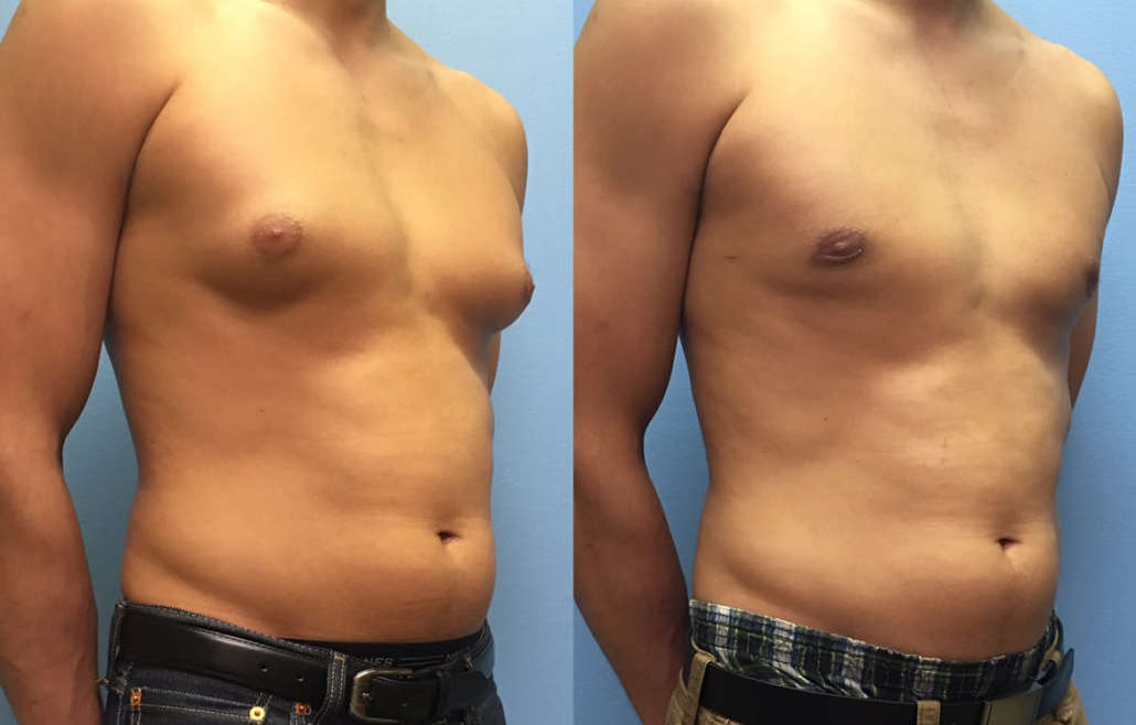 Man's chest before and after a male breast reduction.