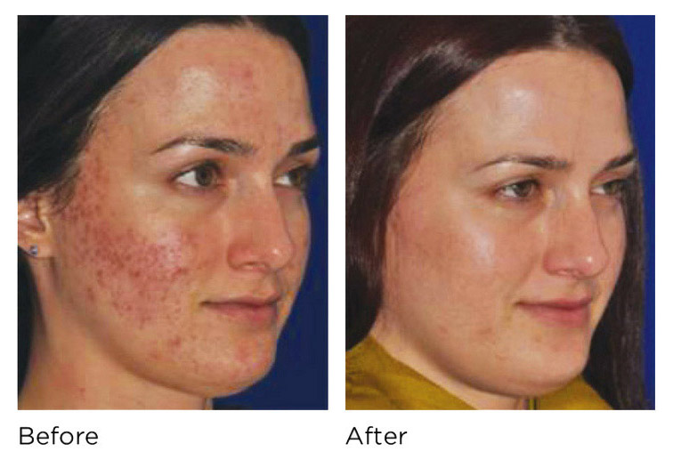 Woman before and after a microneedling procedure to address acne scarring.