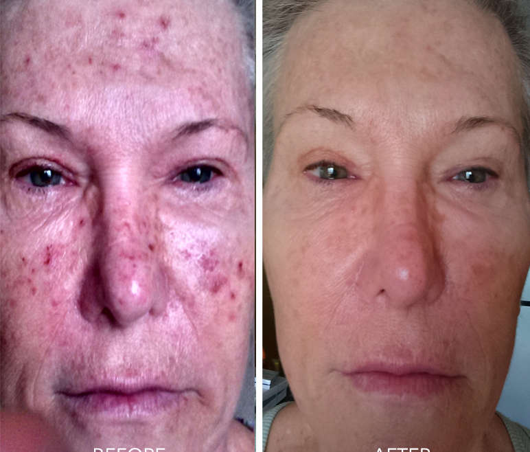 Before and after image of a woman after going through PRP microneedling.