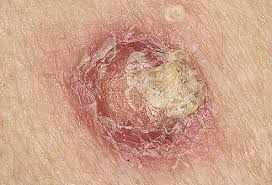 Close-up image of a cancerous skin lesion.