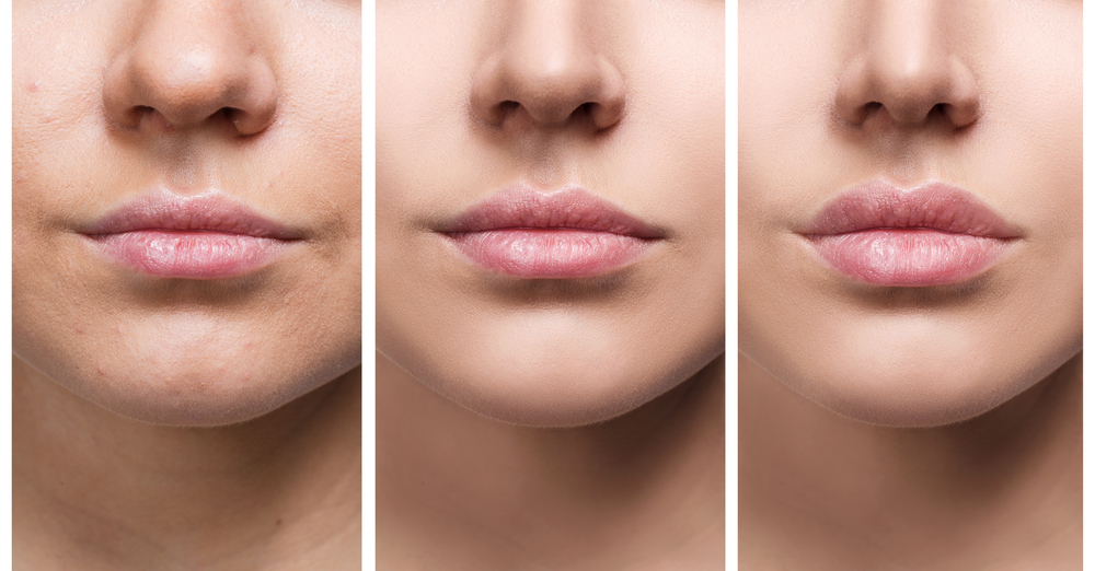 Various images of a woman's face throughout an upper lip procedure.