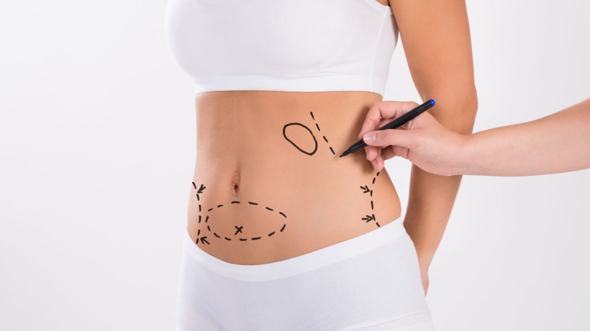 Liposuction-and-Body-Contouring 